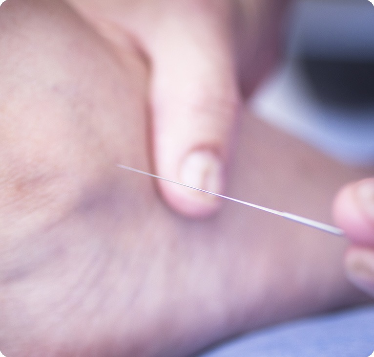 TCM Acupuncture | Lifepath Acupuncture | Lifepath Wellness & Dental