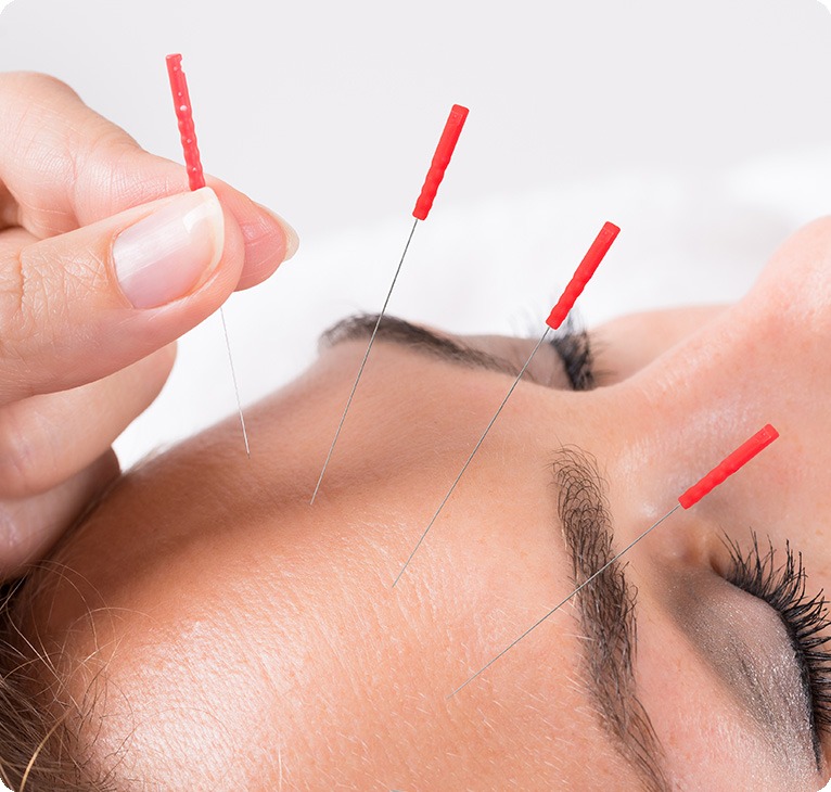 Acupuncture in Forehead | Lifepath Acupuncture | Lifepath Wellness & Dental